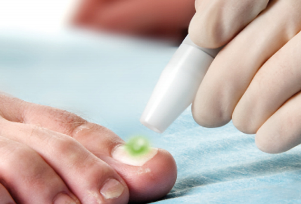 Лечение грибка врач. Лазерная терапия грибка ногтей. Обработка грибковых ногтей. Подология грибок ногтей.